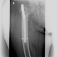 Pertrochanteric fracture, hardware migration, non-union: X-ray - Plain radiograph